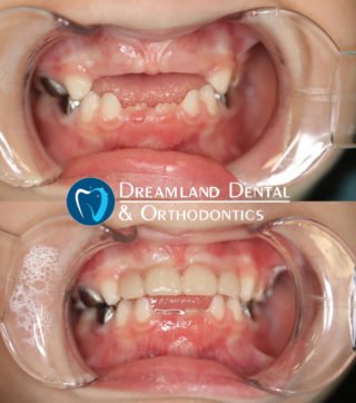 temporary front teeth for child before & after