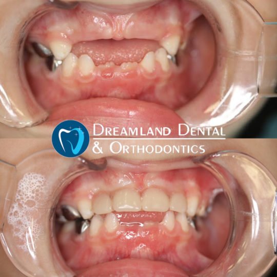 temporary front teeth for child before & after