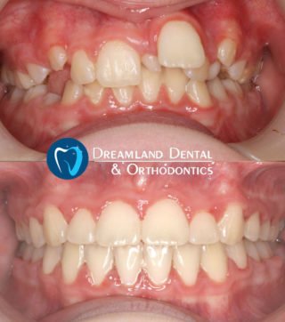 Extraction and Braces, Orthodontics Bellflower Before & After