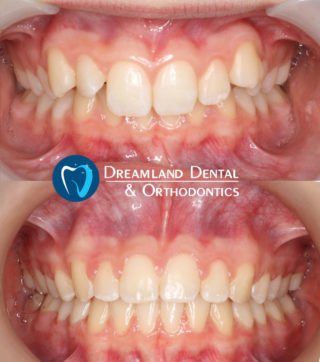Orthodontics Bellflower Before & After 15