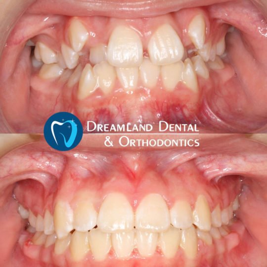 Palatal Expander and Traditional, Braces Orthodontics Bellflower Before & After