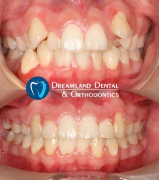 Orthodontics Bellflower Before & After 20