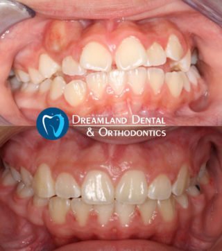 Crowded Teeth, 18 months of orthodontics treatment
