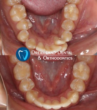 Orthodontics Bellflower Before & After 3