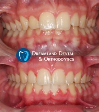 Orthodontics Bellflower Before & After 7