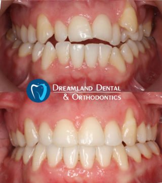 Clear Braces, Orthodontics Bellflower Before & After