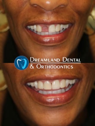 temporary partial denture before & after