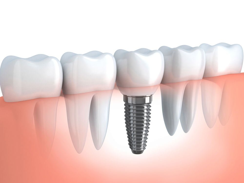 Dental Implants FAQ | Frequently Asked Questions about Dental Implants